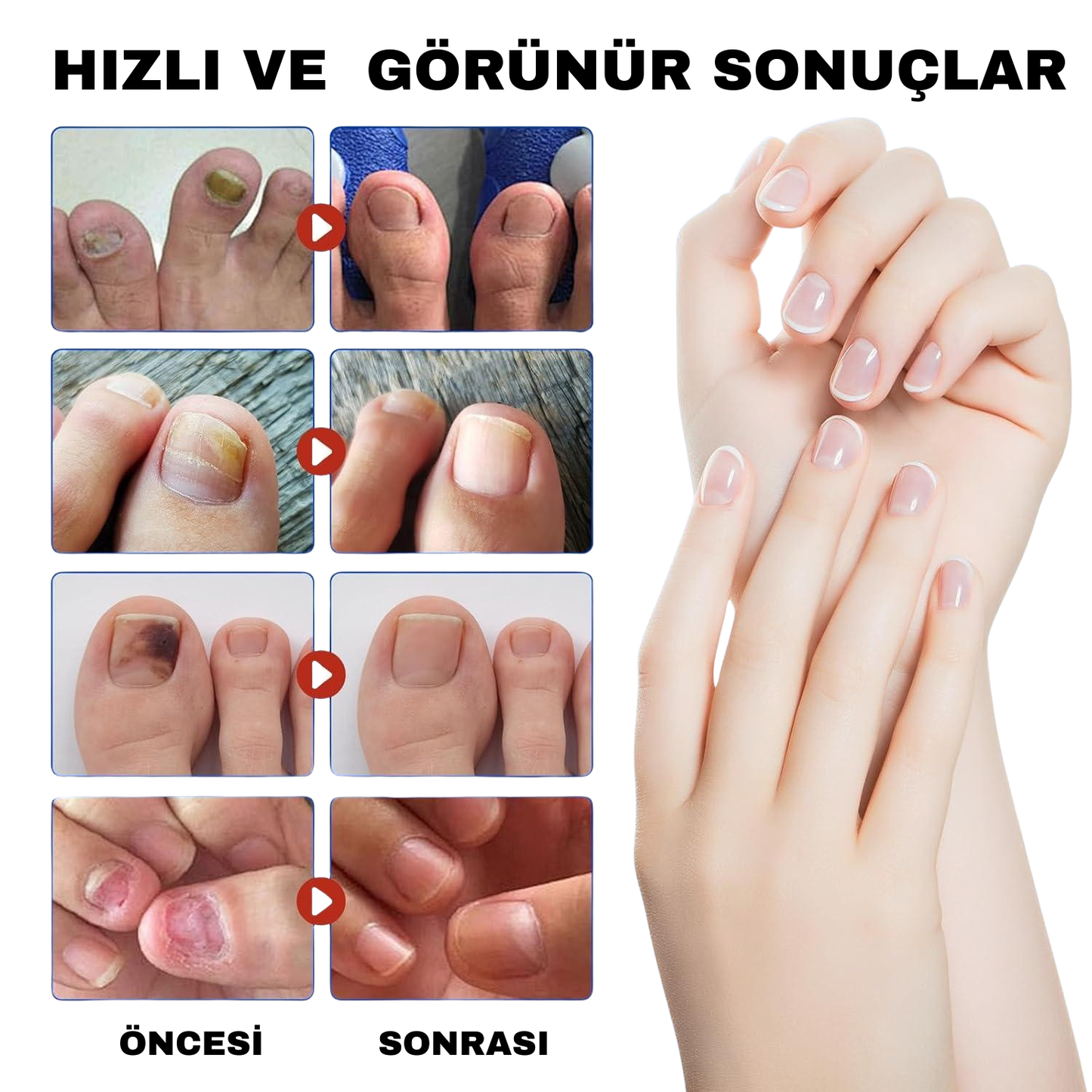 CUREVIA® Tırnak Mantarı İçin Patch – 21’li Paket