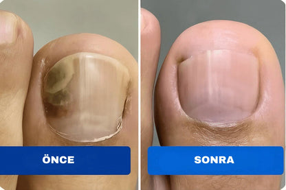 Tırnak Onarım Yaması