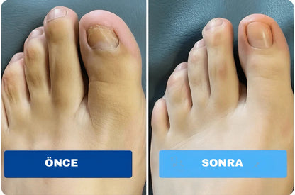 Tırnak Onarım Yaması