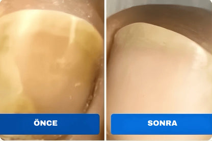 Tırnak Onarım Yaması